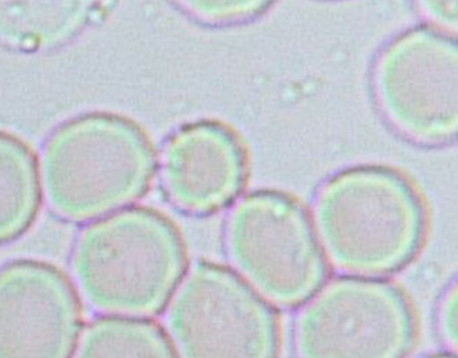 Photocyte Patterns Anisocytosis (macrocytes & microcytes), Ovalocytess, Cloud patterns ...